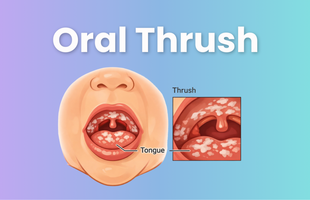 Medical illustration showing oral thrush in a baby's mouth with white patches on the tongue and inner cheeks caused by Candida albicans yeast infection