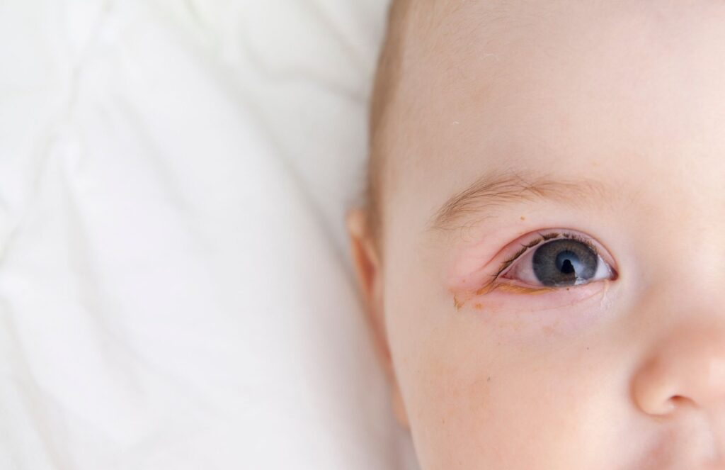 baby-blocked-tear-duct-eye-discharge-closeup-1