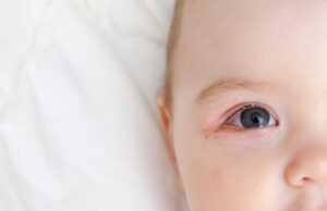 baby-blocked-tear-duct-eye-discharge-closeup-1