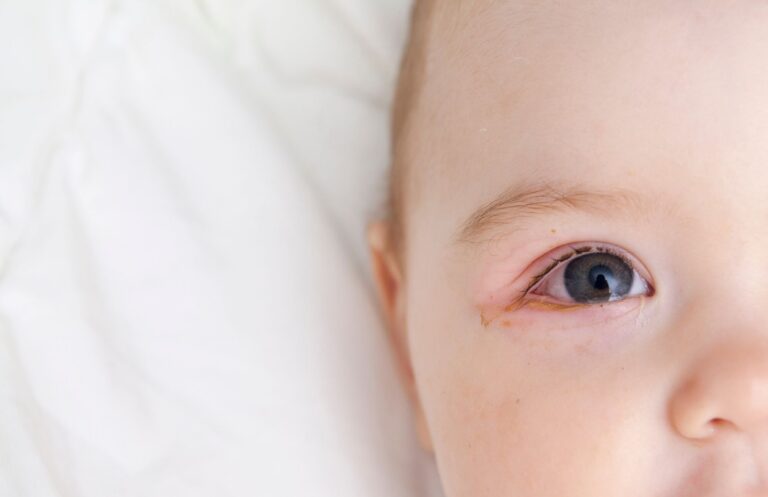 baby-blocked-tear-duct-eye-discharge-closeup-1
