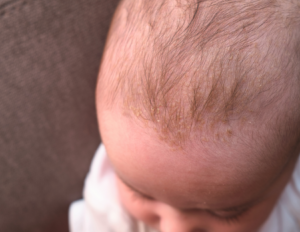 baby-cradle-cap-yellow-flakes-scalp-close-up.jpg
