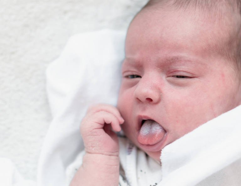 baby-oral-thrush-white-patch-on-tongue-symptom