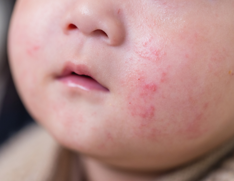 baby-facial-rash-eczema-milk-allergy-skin-reaction.jpg