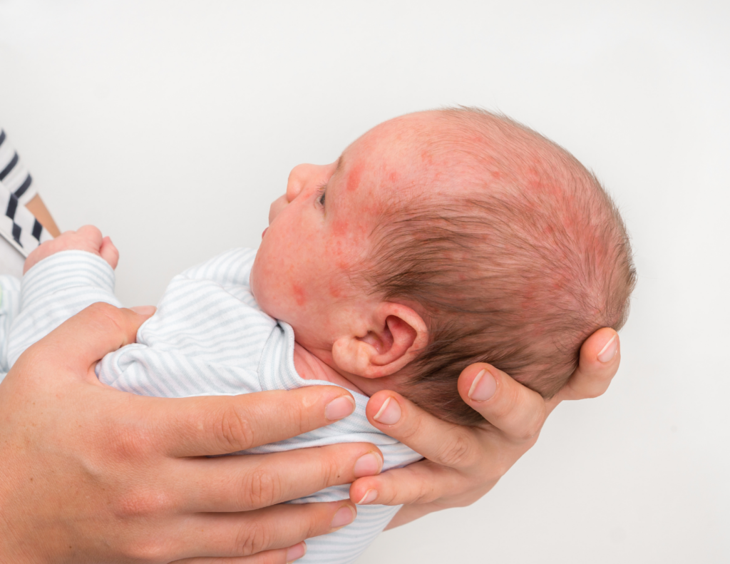 A parent holding a newborn whose face and scalp show widespread red blotchy rash consistent with an allergic skin reaction Caption: A rash that spreads across the face and scalp alongside feeding symptoms is worth a same-day call to your pediatrician — don't wait on this one. SEO description: Photo of a parent's hands carefully supporting a newborn baby in a striped onesie whose face and scalp show widespread red blotchy patches, depicting a skin rash in a newborn that may be associated with cow's milk protein allergy or an allergic reaction requiring pediatric evaluation.  This image is more clinically significant than the cheek rash photo — the rash here is more widespread, covering the face and scalp, which matches the article's description of a more serious allergic presentation. That makes it the stronger image for the "When to Call the Pediatrician Right Away" section rather than the general allergy signs section. Using both rash images gives readers a visual sense of mild versus more widespread reactions, which is genuinely useful for a worried parent trying to gauge severity. Place this one lower in the article near the urgent symptoms section.Sonnet 4.6